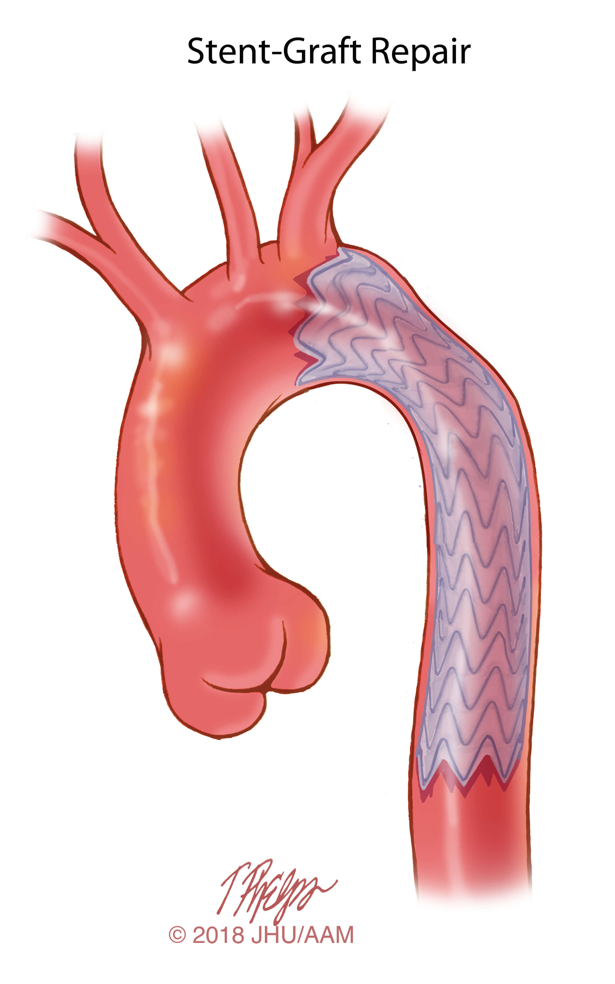 Surgical Treatment Of Congenital Aortic Stenosis By Cardiopulmonary